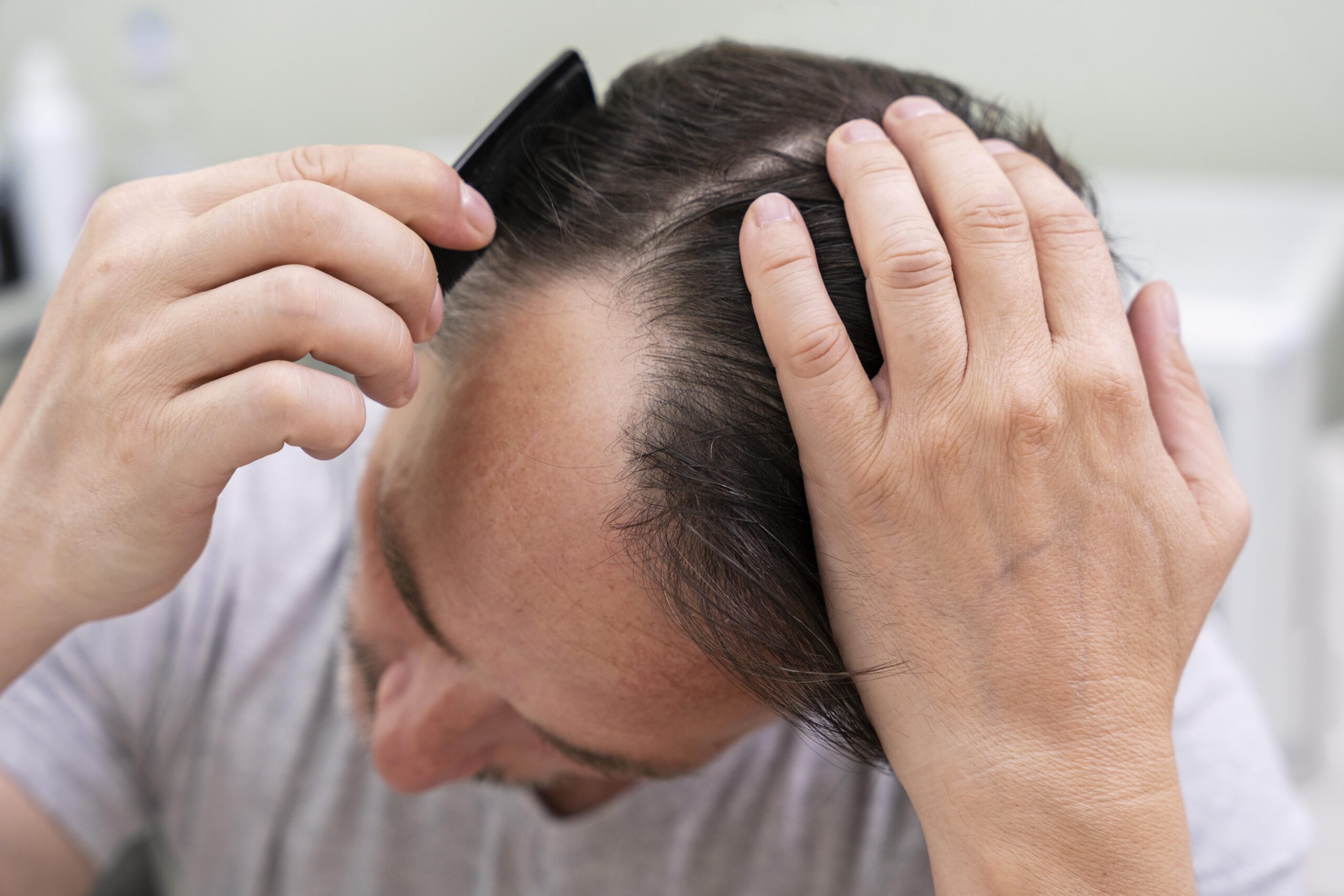 Hair-Loss-Treatment-3