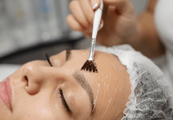 chemical peel for skin lightening