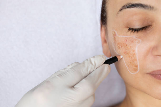 Hyperpigmentation treatment