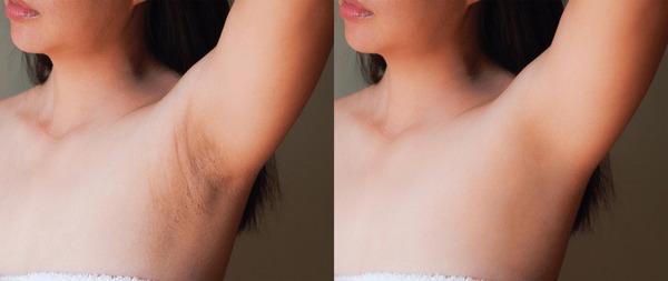 Underarm Whitening
